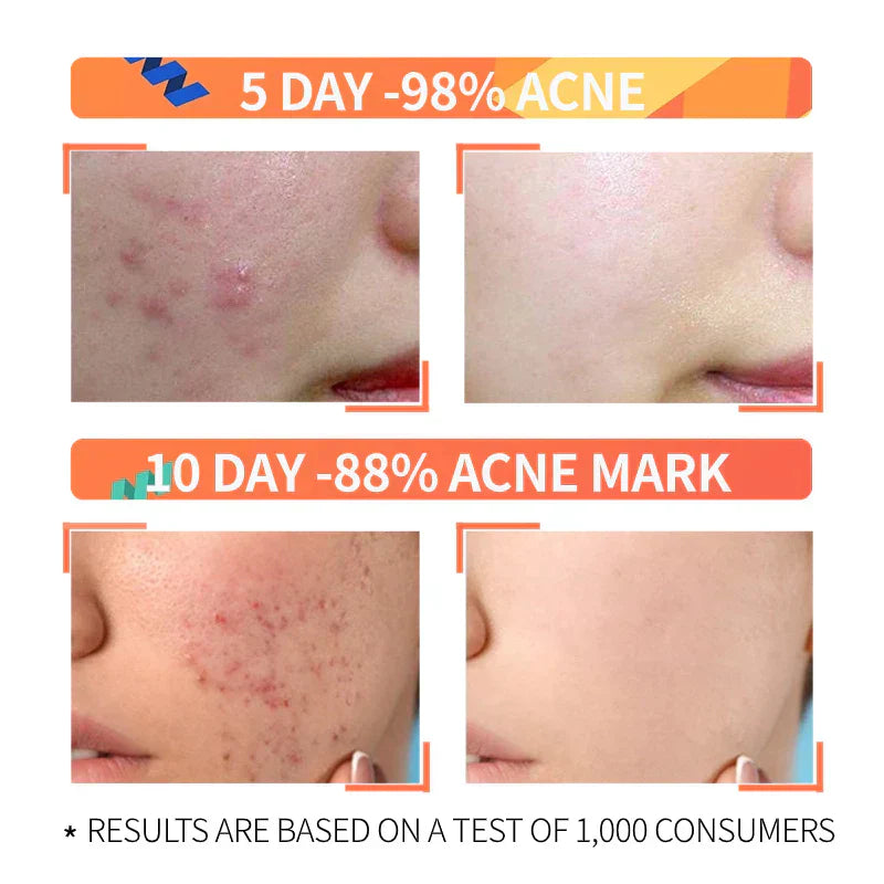 Ordinary Niacinamide Serum BUY 1 GET 1 FREE